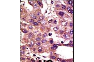 Formalin-fixed and paraffin-embedded human cancer tissue reacted with the primary antibody, which was peroxidase-conjugated to the secondary antibody, followed by DAB staining.