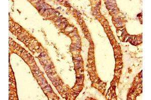 Immunohistochemistry of paraffin-embedded human endometrial cancer using ABIN7142242 at dilution of 1:100 (MRPS10 anticorps  (AA 1-201))