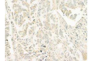 ABIN6261918 and ABIN6278469 at 1/100 staining human lung squamous cell carcinoma by IHC-P. (GUCY1B2 anticorps)