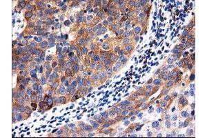 Immunohistochemical staining of paraffin-embedded Carcinoma of Human kidney tissue using anti-ALDH1L1 mouse monoclonal antibody. (ALDH1L1 anticorps)