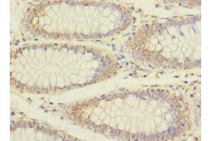 Immunohistochemistry of paraffin-embedded human colon cancer using ABIN7151990 at dilution of 1:100 (ERBB2IP anticorps  (AA 1193-1412))