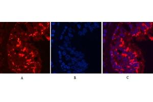 Immunofluorescence analysis of human lung cancer tissue. (CD68 anticorps)