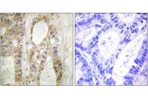 Immunohistochemistry analysis of paraffin-embedded human colon carcinoma, using Chk1 (Ab-296) Antibody. (CHEK1 anticorps  (AA 266-315))