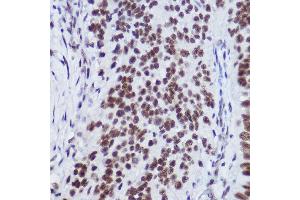 Immunohistochemistry of paraffin-embedded human lung cancer using USP39 Rabbit mAb (ABIN7271160) at dilution of 1:100 (40x lens).