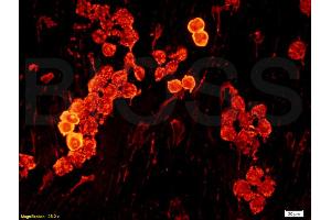 Formalin-fixed and paraffin embedded human oral squamous cell carcinoma labeled with Anti-laminin Polyclonal Antibody, Unconjugated (ABIN728638) at 1:200, followed by conjugation to the secondary antibody.