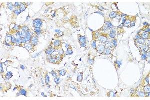 Immunohistochemistry of paraffin-embedded Human breast cancer using TIMP2 Polyclonal Antibody at dilution of 1:150 (40x lens). (TIMP2 anticorps)