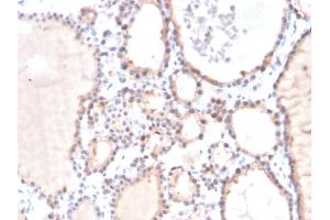 Formalin-fixed, paraffin-embedded human Prostate Carcinoma stained with Lactoylglutathione Lyase Mouse Monoclonal Antibody (CPTC-GLO1-3). (GLO1 anticorps)