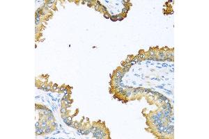 Immunohistochemistry of paraffin-embedded human prostate using VEGFC antibody at dilution of 1:100 (40x lens). (VEGFC anticorps)