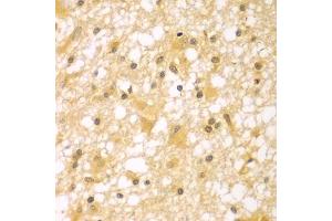 Immunohistochemistry of paraffin-embedded human brain cancer using PAK6 antibody (ABIN5975652) at dilution of 1/100 (40x lens). (PAK6 anticorps)