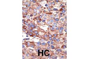 Formalin-fixed and paraffin-embedded human hepatocellular carcinoma tissue reacted with YY1 polyclonal antibody  , which was peroxidase-conjugated to the secondary antibody, followed by DAB staining . (YY1 anticorps  (Internal Region))