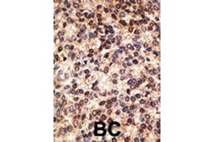Formalin-fixed and paraffin-embedded human breast cancer tissue reacted with JAG2 polyclonal antibody  , which was peroxidase-conjugated to the secondary antibody, followed by DAB staining. (JAG2 anticorps  (C-Term))