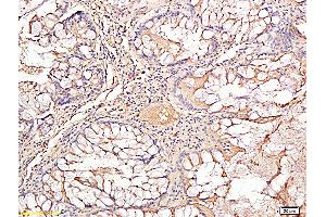 Formalin-fixed and paraffin embedded human rectal carcinoma labeled with Rabbit Anti TIMP-1 Polyclonal Antibody, Unconjugated (ABIN707441) at 1:200 followed by conjugation to the secondary antibody and DAB staining
