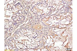 Formalin-fixed and paraffin embedded human rectal carcinoma labeled with Rabbit Anti TIMP-1 Polyclonal Antibody, Unconjugated (ABIN707441) at 1:200 followed by conjugation to the secondary antibody and DAB staining (TIMP1 anticorps  (AA 131-207))