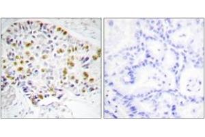 Immunohistochemistry analysis of paraffin-embedded human lung carcinoma tissue, using Retinoblastoma (Ab-249) Antibody. (Retinoblastoma Protein (Rb) anticorps  (AA 211-260))