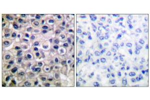 Immunohistochemical analysis of paraffin-embedded human breast carcinoma tissue using MMP-14 antibody (ABIN5976458). (MMP14 anticorps  (C-Term))