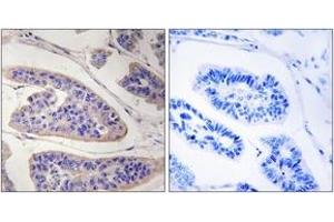 Immunohistochemistry analysis of paraffin-embedded human breast carcinoma tissue, using ENAH Antibody.