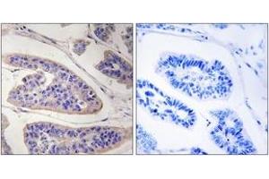 Immunohistochemistry analysis of paraffin-embedded human breast carcinoma tissue, using ENAH Antibody. (ENAH anticorps  (AA 472-521))