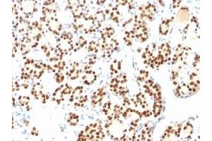 Formalin-fixed, paraffin-embedded human thyroid stained with TTF1 antibody (8G7G3/1 + NX2. (TTF1 anticorps)