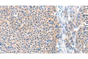 Immunohistochemistry of paraffin-embedded Human liver cancer tissue using ADAM20 Polyclonal Antibody at dilution 1:50 (ADAM20 anticorps)
