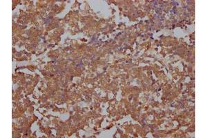 IHC image of ABIN7127851 diluted at 1:100 and staining in paraffin-embedded human lung cancer performed on a Leica BondTM system. (Recombinant Topoisomerase II alpha anticorps)