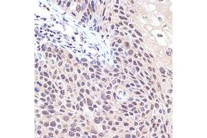 Immunohistochemistry of paraffin-embedded human esophageal cancer using Transportin 3 (Transportin 3 (TNPO3)) Rabbit mAb (ABIN7270971) at dilution of 1:100 (40x lens).