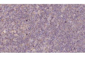 ABIN6273144 at 1/100 staining Human lymph cancer tissue by IHC-P. (NDUFB11 anticorps  (N-Term))