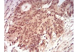 Immunohistochemical analysis of paraffin-embedded rectum cancer tissues using RAN mouse mAb with DAB staining. (RAN anticorps  (AA 1-216))