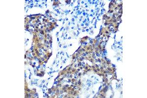 Immunohistochemistry of paraffin-embedded human cervix cancer using [KO Validated] CDKN2A/p16INK4a Rabbit mAb (ABIN6131541, ABIN6139280, ABIN6139282 and ABIN7101380) at dilution of 1:100 (40x lens).