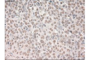 Immunohistochemical staining of paraffin-embedded Adenocarcinoma of breast tissue using anti-SOX17 mouse monoclonal antibody. (SOX17 anticorps  (AA 177-414))