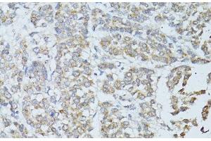 Immunohistochemistry of paraffin-embedded Human colon carcinoma using TEFM Polyclonal Antibody at dilution of 1:100 (40x lens). (TEFM anticorps)