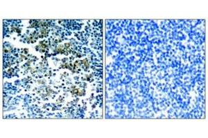 Immunohistochemical analysis of paraffin-embedded human tonsil tumor tissue using Bcr(Phospho-Tyr177) Antibody(left) or the same antibody preincubated with blocking peptide(right). (BCR anticorps  (pTyr177))