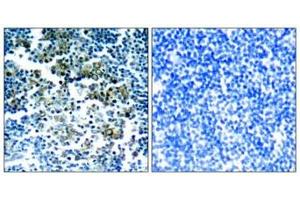 Immunohistochemical analysis of paraffin-embedded human tonsil tumor tissue using Bcr(Phospho-Tyr177) Antibody(left) or the same antibody preincubated with blocking peptide(right).