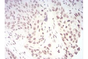 Immunohistochemical analysis of paraffin-embedded esophageal cancer tissues using TERT mouse mAb with DAB staining. (TERT anticorps  (AA 1029-1132))
