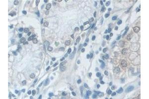 Detection of VCP in Human Stomach cancer Tissue using Polyclonal Antibody to Valosin Containing Protein (VCP)