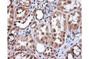 Immunohistochemical staining of paraffin-embedded Carcinoma of liver tissue using anti-MTRF1L mouse monoclonal antibody. (MTRF1L anticorps)