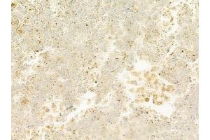 ABIN6266143 and ABIN6273188 at 1/100 staining human melanoma by IHC-P.