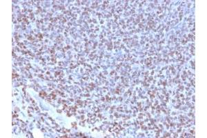 IHC testing of FFPE Ewings sarcoma with recombinant NKX2. (Nkx2-2 anticorps  (AA 1-119))