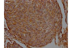 IHC image of ABIN7127493 diluted at 1:100 and staining in paraffin-embedded human cervical cancer performed on a Leica BondTM system. (Recombinant Filamin A anticorps)