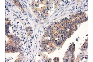 Immunohistochemical staining of paraffin-embedded Adenocarcinoma of Human colon tissue using anti-RTN4IP1 mouse monoclonal antibody. (RTN4IP1 anticorps)