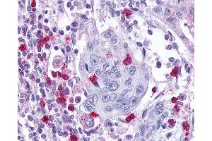 Anti-Leukotriene B4 Receptor / BLT1 antibody IHC of human Pancreas, Carcinoma and Leukocytes.