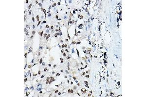 Immunohistochemistry of paraffin-embedded Human lung cancer using CEBPA Rabbit pAb (ABIN6131380, ABIN6138380, ABIN6138381 and ABIN6214018) at dilution of 1:100 (40x lens).