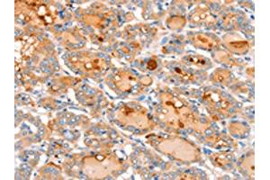 The image on the left is immunohistochemistry of paraffin-embedded Human thyroid cancer tissue using ABIN7128172(ACOX2 Antibody) at dilution 1/20, on the right is treated with fusion protein. (Acox2 anticorps)
