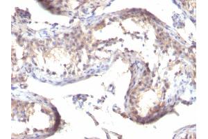 Formalin-fixed, paraffin-embedded human Testicular Carcinoma stained with TGF alpha Mouse Monoclonal Antibody (MF9) (TGFA anticorps  (C-Term))