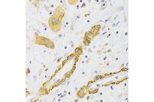 Immunohistochemistry of paraffin-embedded human liver cancer using KIF1B Antibody.