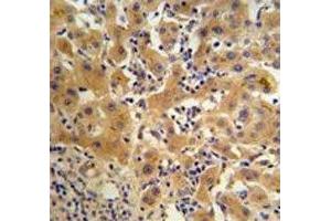 Ceruloplasmin antibody IHC analysis in formalin fixed and paraffin embedded human hepatocarcinoma