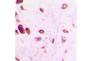 Immunohistochemical analysis of AP2 alpha/beta staining in human lung cancer formalin fixed paraffin embedded tissue section. (AP2 alpha/beta (C-Term) anticorps)