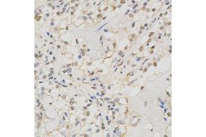 Immunohistochemistry of paraffin-embedded human kidney cancer using MSH2 antibody at dilution of 1:200 (x400 lens). (MSH2 anticorps)