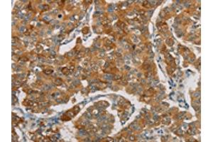 The image on the left is immunohistochemistry of paraffin-embedded Human breast cancer tissue using ABIN7190690(FOXF2 Antibody) at dilution 1/30, on the right is treated with synthetic peptide. (FOXF2 anticorps)