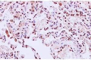 Immunohistochemistry of paraffin-embedded Human lung using STIL Polyclonal Antibody at dilution of 1:200 (STIL anticorps)