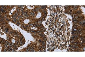 Immunohistochemistry of paraffin-embedded Human colon cancer using PPP1R13L Polyclonal Antibody at dilution of 1:30 (PPP1R13L anticorps)